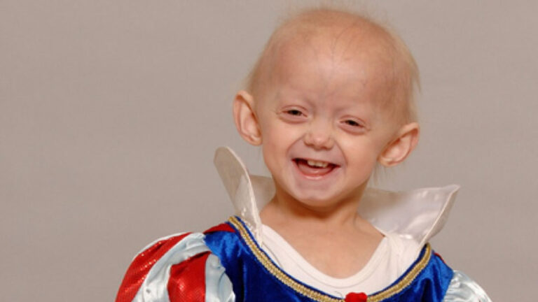 An Early Diagnosis of Hutchinson-Gilford Progeria Syndrome