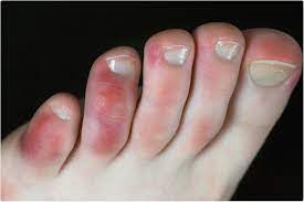 Charting the Sequelae of COVID Toes in 3 Paediatric Patients