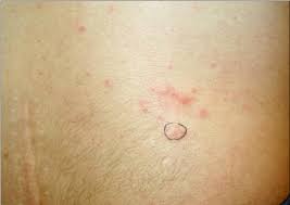 Papulonodular Mucinosis: A Rare Skin Manifestation of Systemic Lupus Erythematosus in a Child