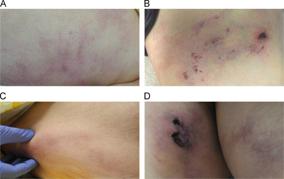 Calciphylaxis: Clinical Features, Therapeutic Options, and Outcomes
