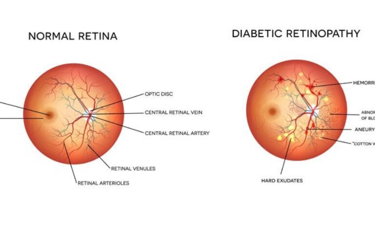 Association between the Urinary Proteome and Diabetic Retinopathy in the direct protect 1 and 2 trials
