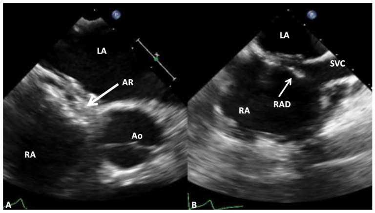 Closure of Large Atrial Septal Defects in Children and Adults Using the GORE CARDIOFORM ASD Occluder