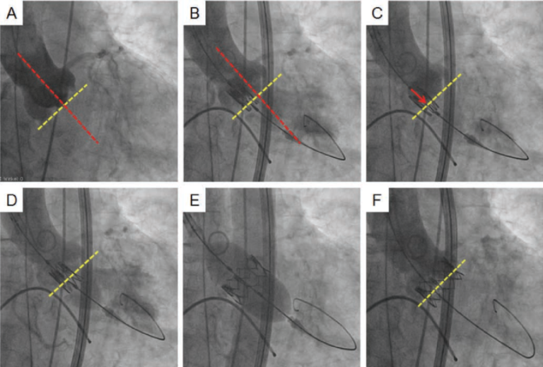 Real-Time Hemodynamic Monitoring During TAVR, Stepping Toward the Ideal TAVR Wire