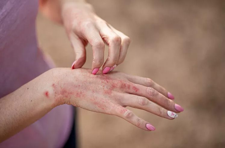Severe Atopic Eczema Is Associated with Reduced Acne Vulgaris in Bangladeshi Children and Young Adults: A Retrospective Analysis from A Cross-Sectional Study
