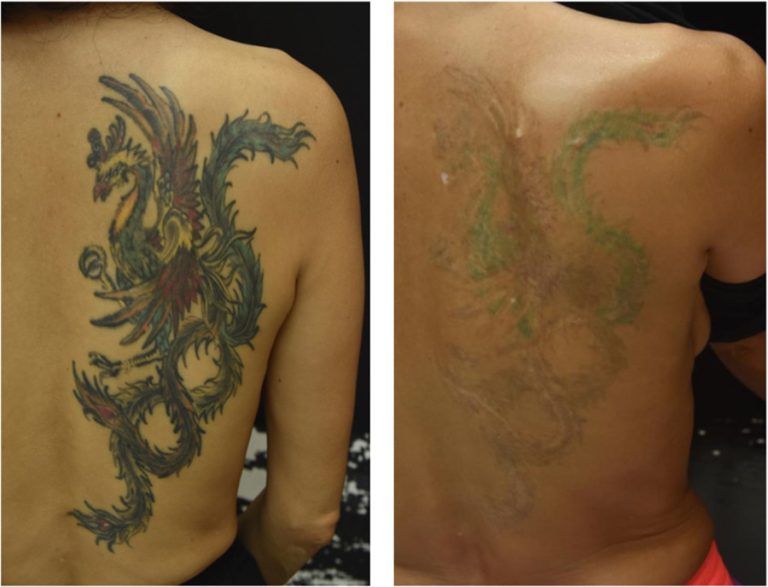 Efficacy And Safety of Picosecond Nd-YAG Laser For Tattoo Removal in Asian Patients: A Way to Look Forward