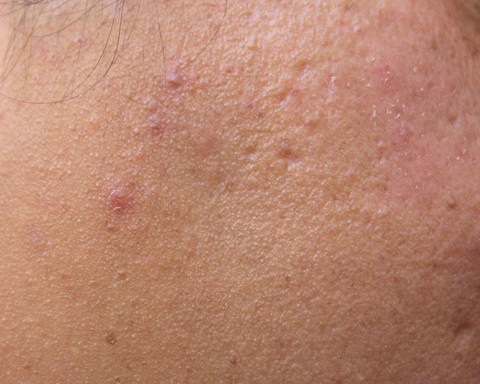 Management Of Acne and Rosacea -An Update
