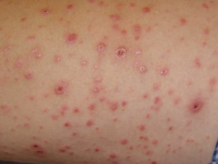 New-Onset Agminated Spitz Naevi Following Hypopigmented Pityriasis Lichenoides Chronica