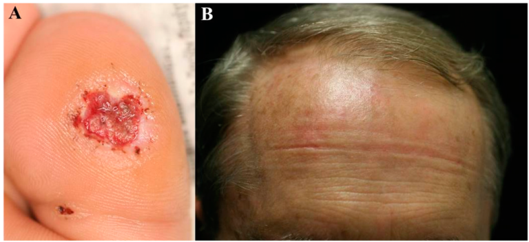 Safety And Efficacy of Aminolevulinic Acid 20% Topical Solution Activated by Pulsed Dye Laser and Blue Light in The Treatment of In Situ Facial Squamous Cell Carcinoma