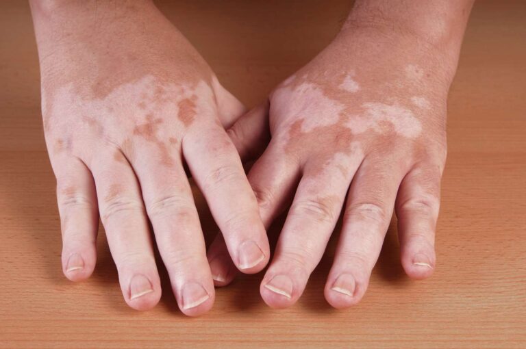 Global Prevalence of Autoimmune Diseases in Patients with Vitiligo: A Systematic Review