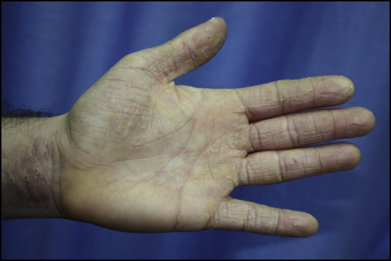 Immunohistochemical Differentiation of Keratins and Involucrin between Palmar Psoriasis, Chronic Hand Eczema, and Hyperkeratotic Hand Dermatitis