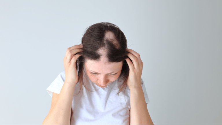 Pooled Patient-Reported Outcomes from the Phase 3 THRIVE-AA1 and THRIVE-AA2 Trials of Deuruxolitinib in Adult Patients with Moderate to Severe Alopecia Areata